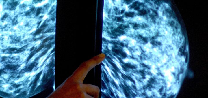Grieving husband describes ‘shell shock’ after realising leisurely companion could even personal no longer personal been invited for breast most cancers tests