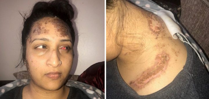 Lady’s severe burns after ‘schoolboy’ lobbed a bottle of acid at her